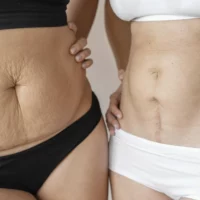 Post-partum